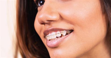 diferencia de precio brackets metalicos o esteticos|brackets aesthetic pros y cons.